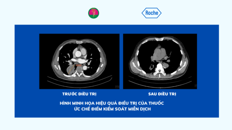 LIỆU PHÁP MIỄN DỊCH – KỶ NGUYÊN MỚI TRONG ĐIỀU TRỊ UNG THƯ PHỔI KHÔNG TẾ BÀO NHỎ