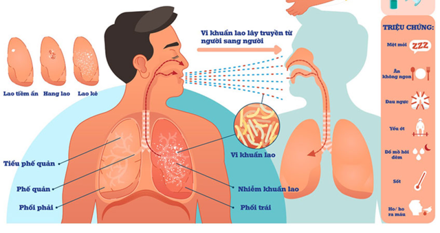 Yếu tố nguy cơ và cách phòng ngừa lao phổi